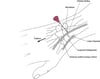 Arthrozentese des Handgelenks