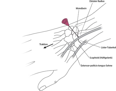 Arthrozentese des Handgelenks