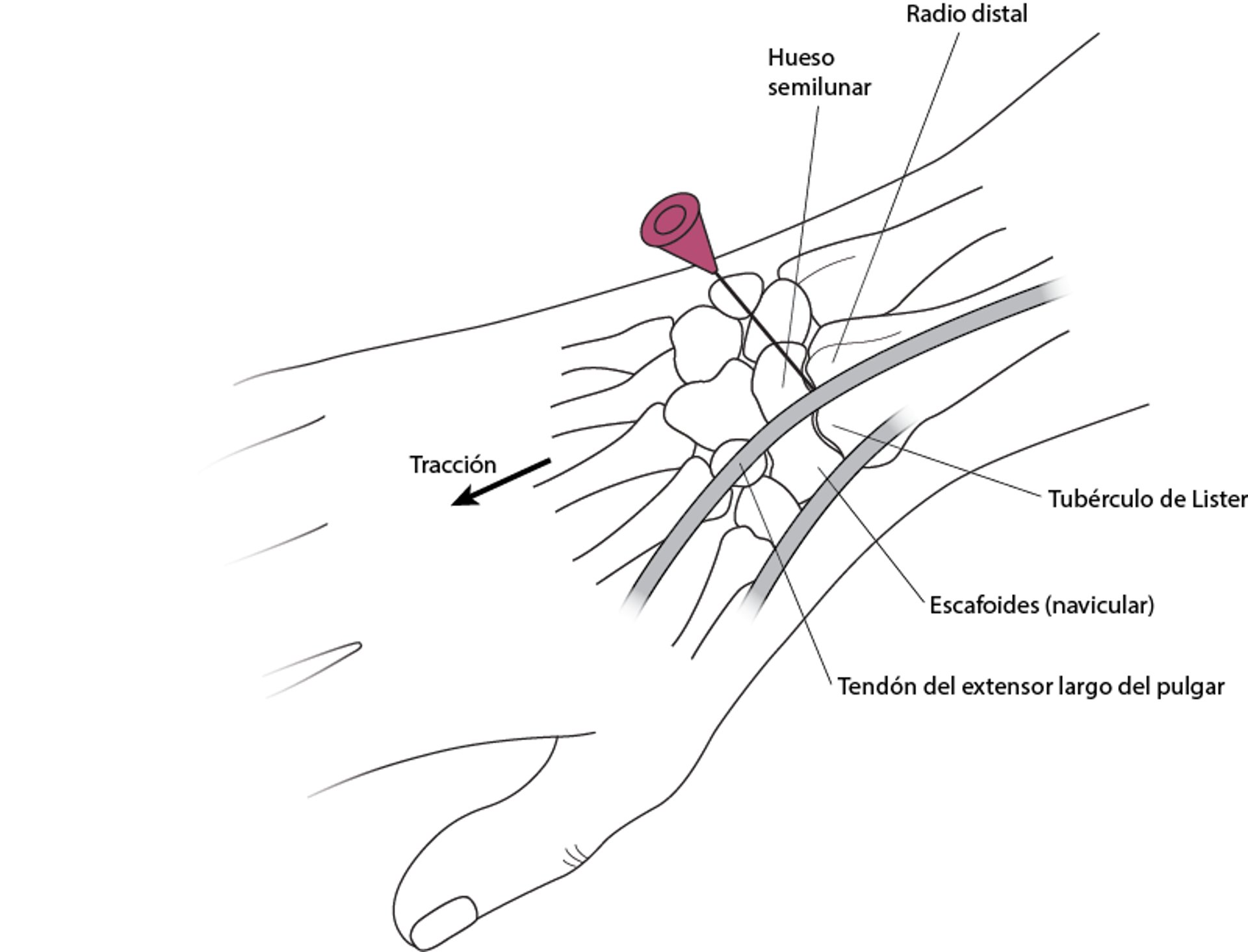 Artrocentesis de la muñeca