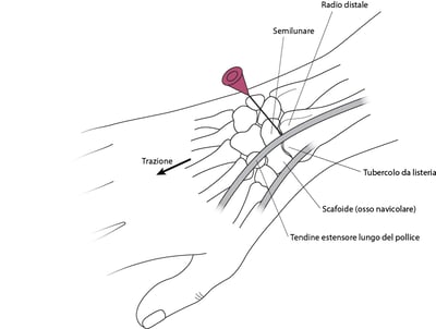 Artrocentesi del polso