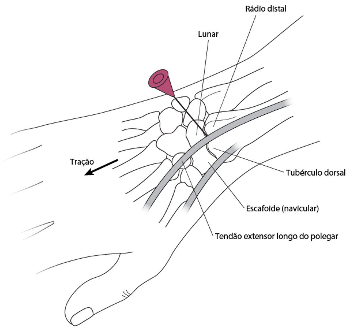 Artrocentese do punho