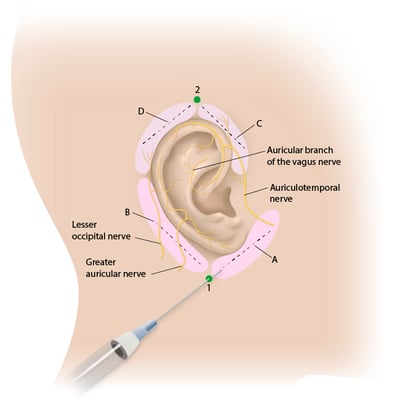 Auricular Block