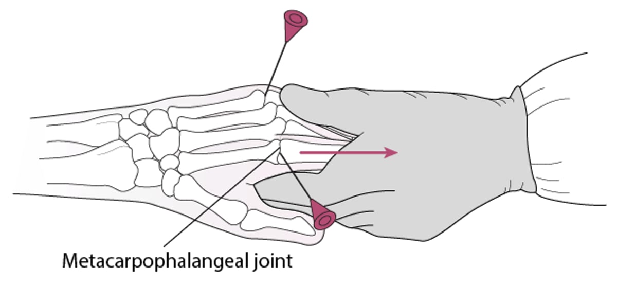 Artrocentesis de la articulación metatarsofalángica