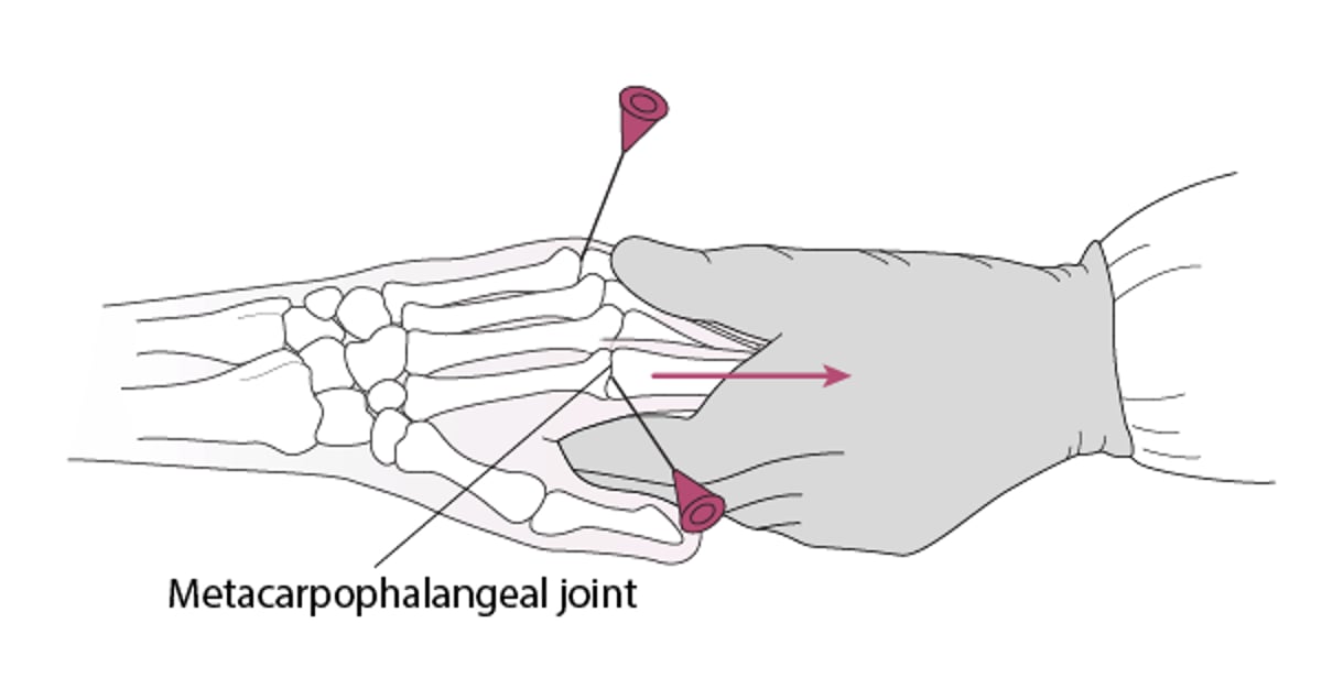 Arthrocentèse de l'articulation métacarpophalangienne