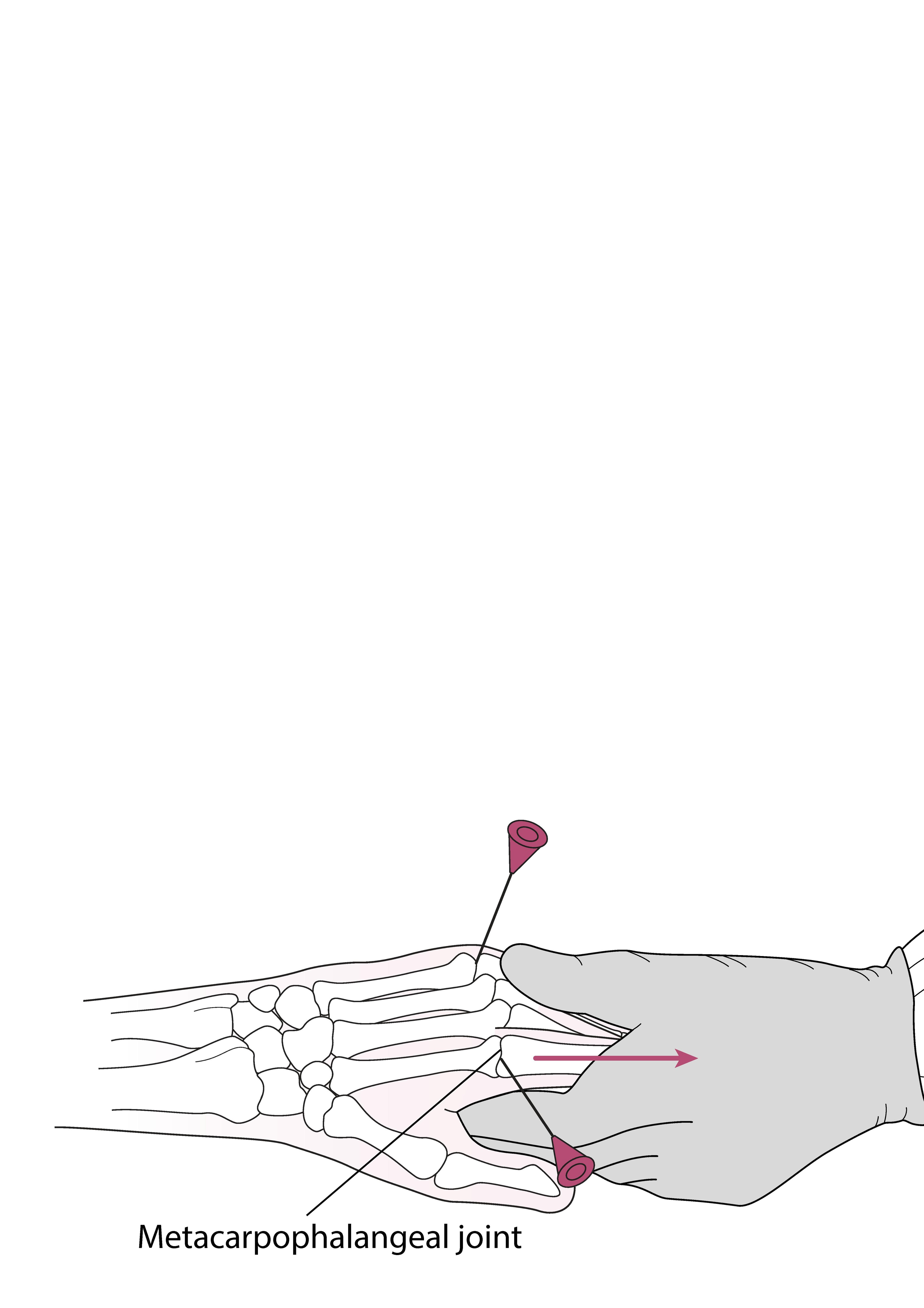 Artrocentesi dell'articolazione metacarpofalangea