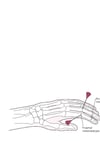 Arthrozentese des proximalen Interphalangealgelenkes