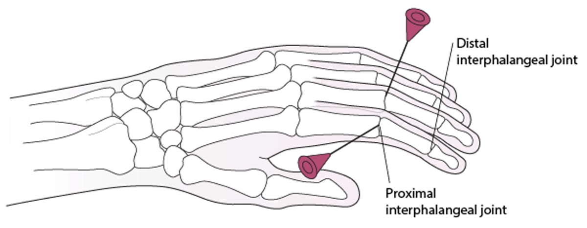 Artrocentesis de la articulación interfalángica proximal