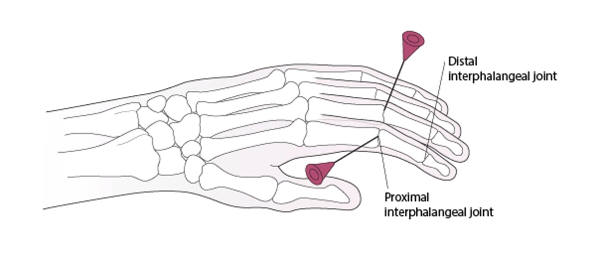 Arthrocentèse de l'articulation interphalangienne proximale