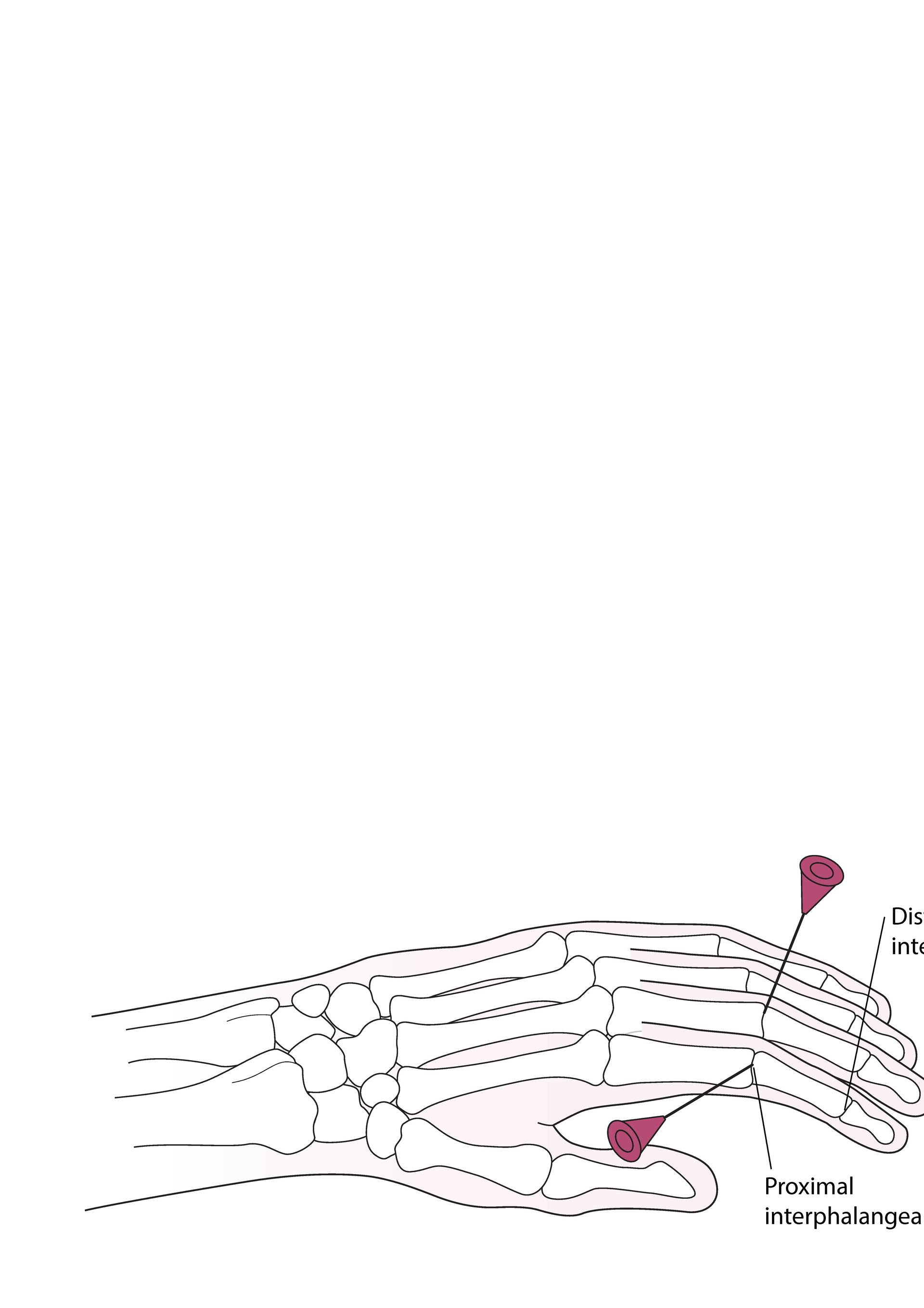 Artrocentesi dell'articolazione interfalangea prossimale