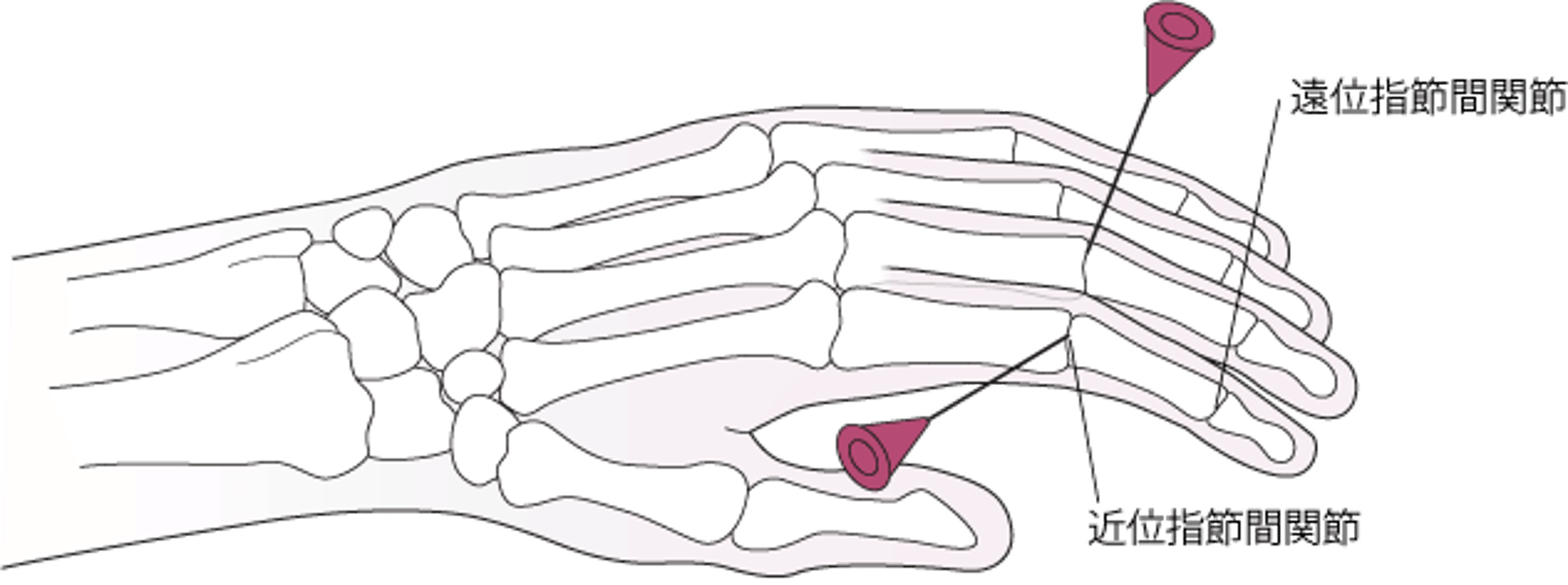 近位指節間関節の関節穿刺