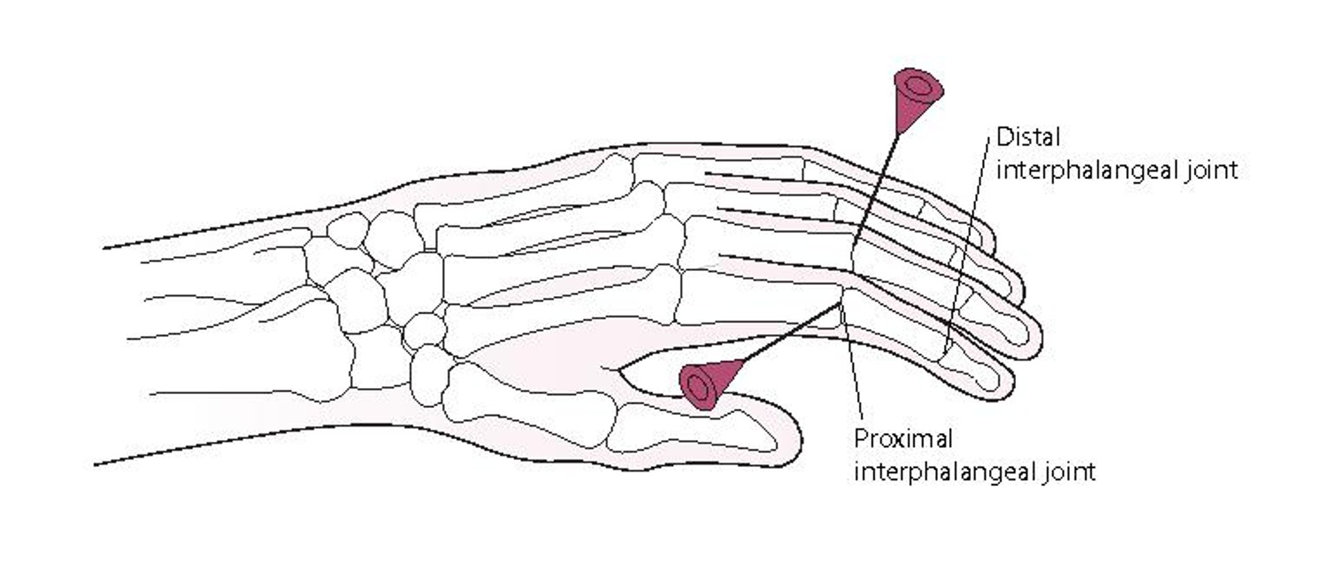 Artrocentese da articulação interfalângica proximal