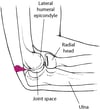 Arthrocentesis of the elbow