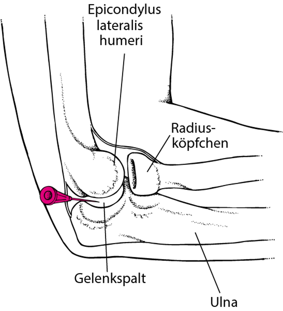 Arthrozentese des Ellbogens.