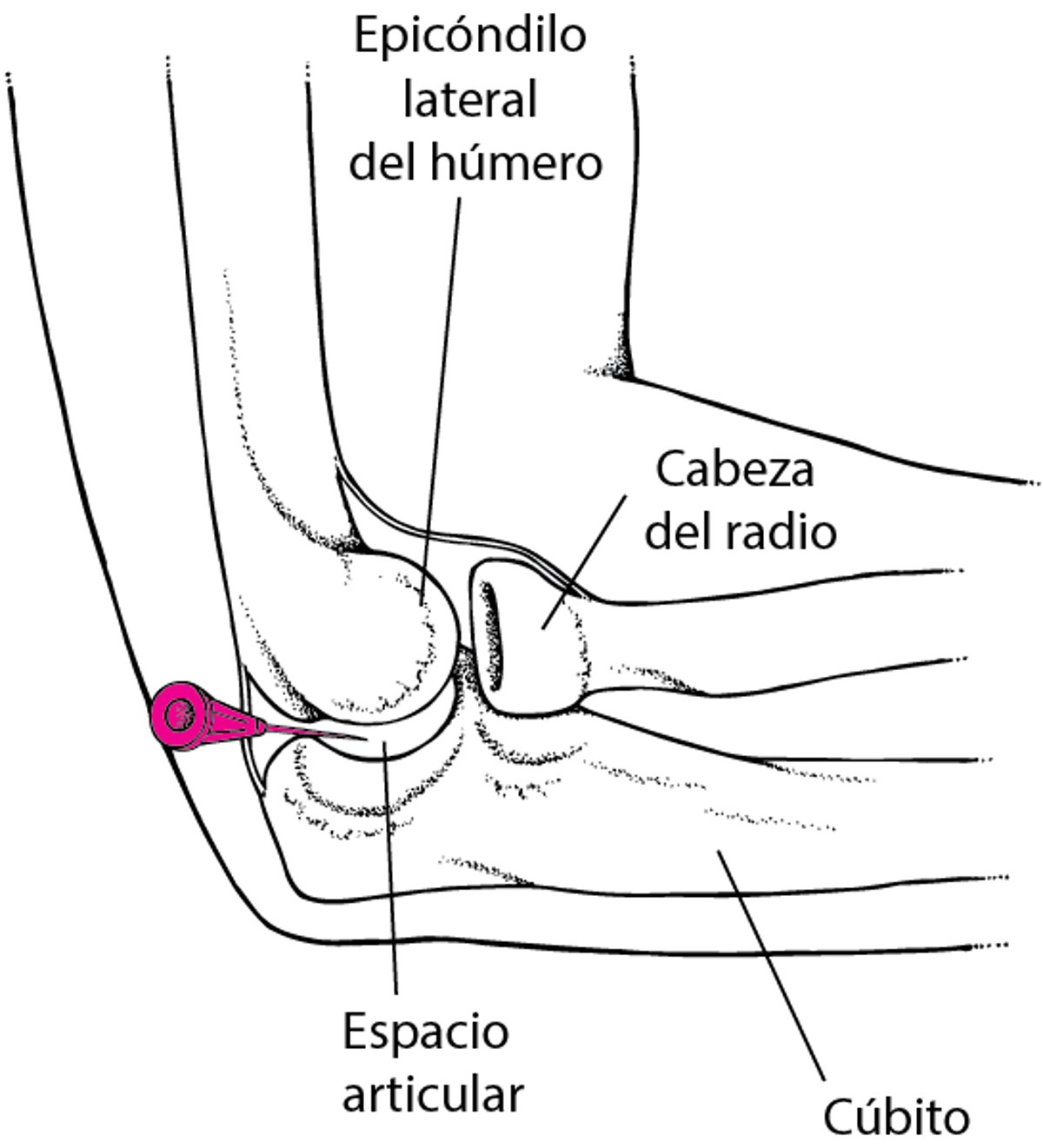 Artrocentesis del codo