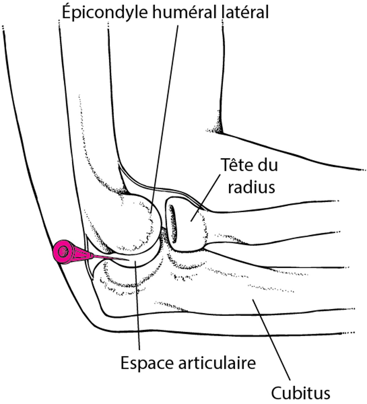 Arthrocentèse du coude