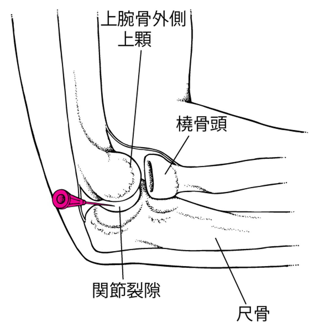 肘関節の関節穿刺