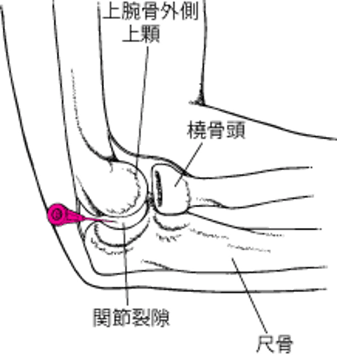 肘関節の関節穿刺