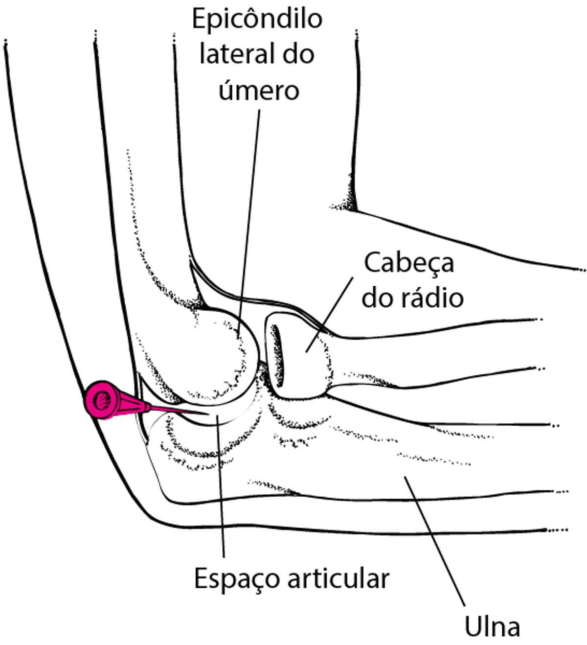 Artrocentese do cotovelo