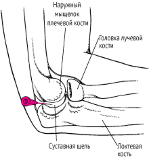 Артроцентез локтевого сустава