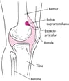 Artrocentesis de la rodilla
