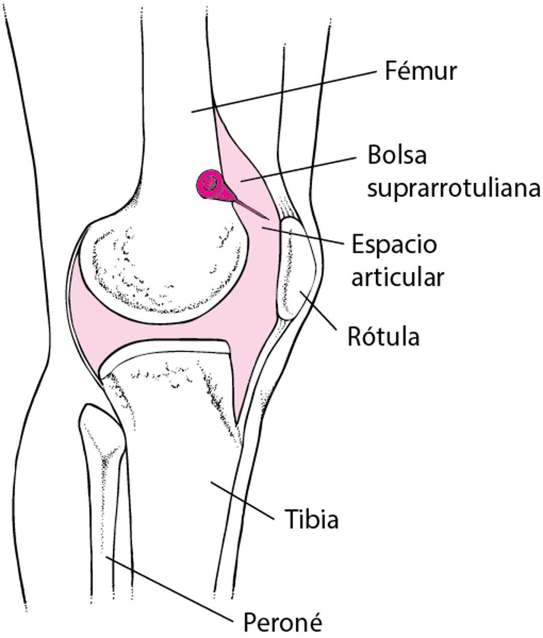 Artrocentesis de la rodilla