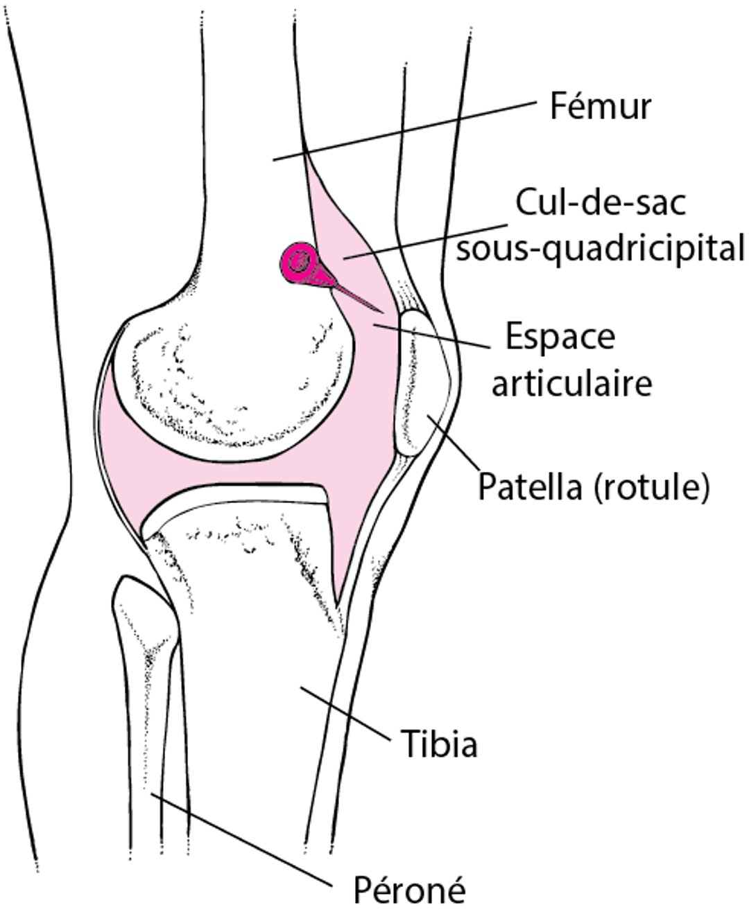 Arthrocentèse du genou