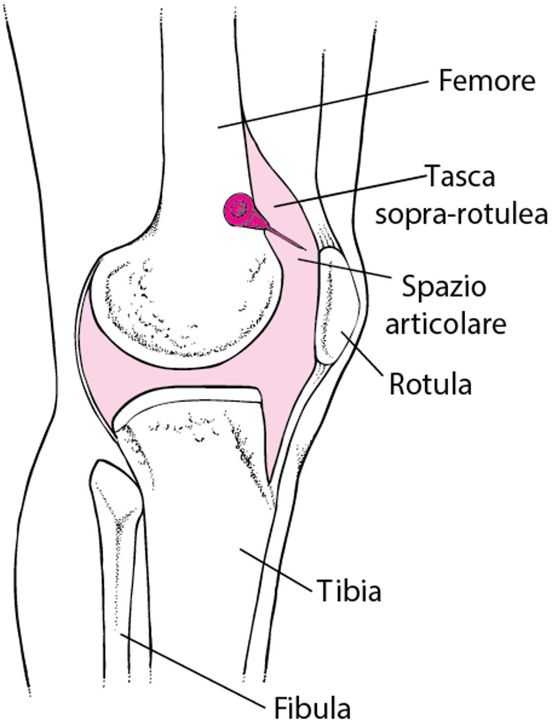 Artrocentesi del ginocchio