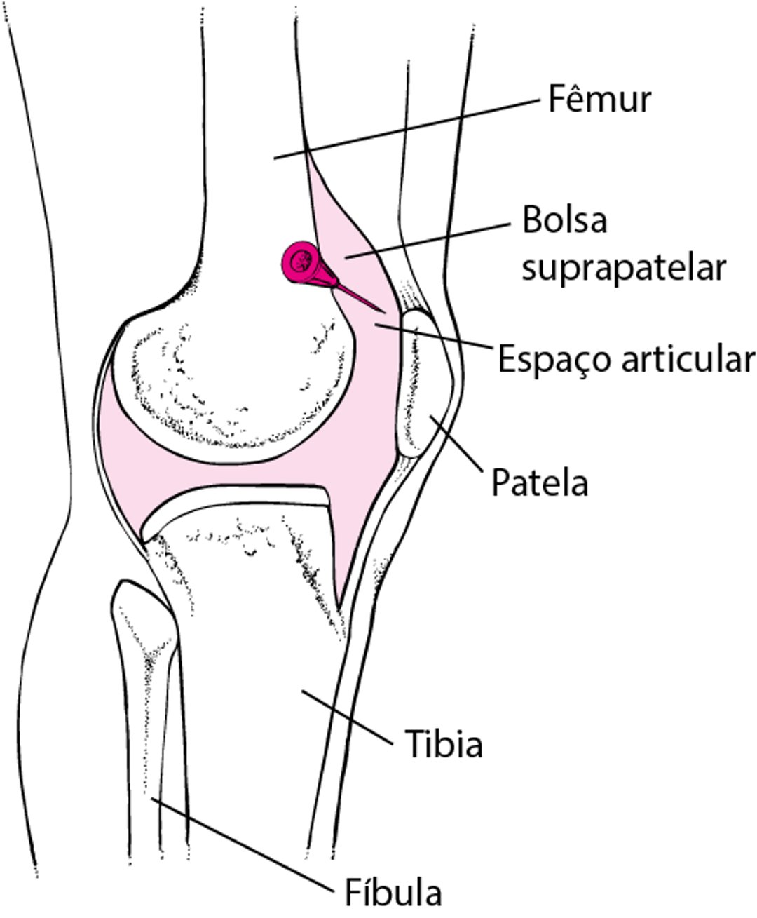 Artrocentese do joelho