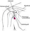 Arthrozentese der Schulter