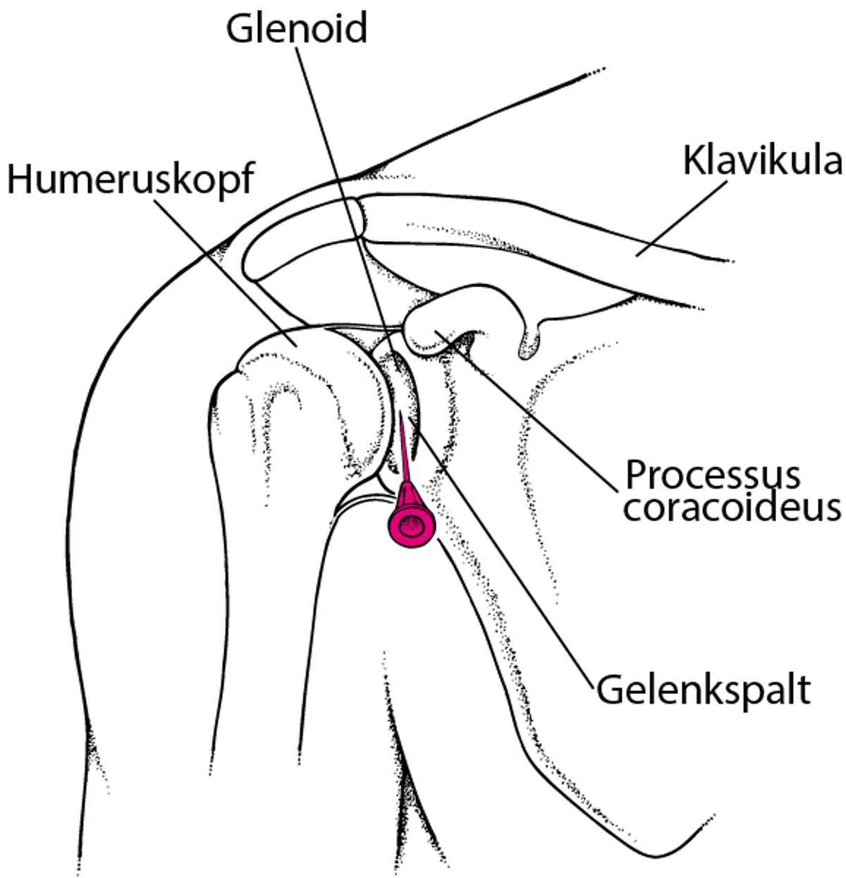 Arthrozentese der Schulter