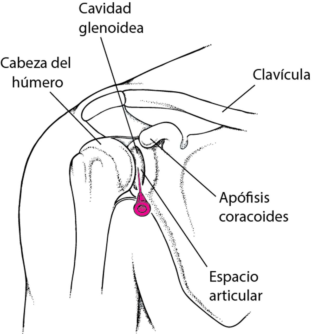 Artrocentesis del hombro