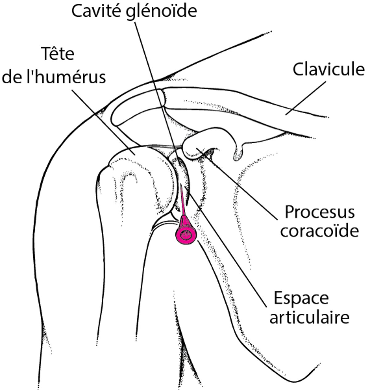 Arthrocentèse de l'épaule