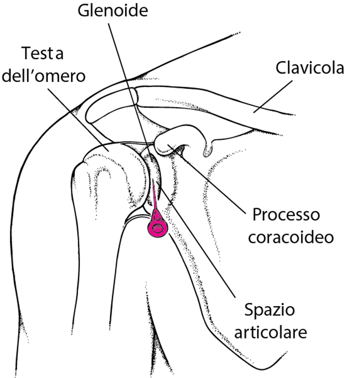 Artrocentesi della spalla