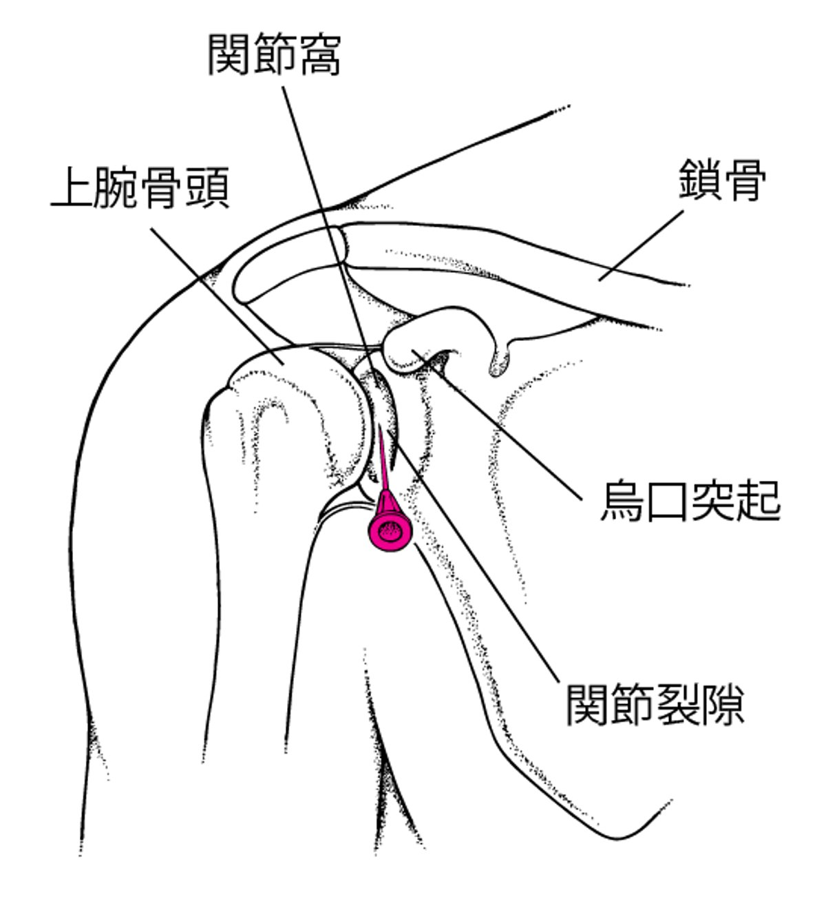 肩関節の関節穿刺