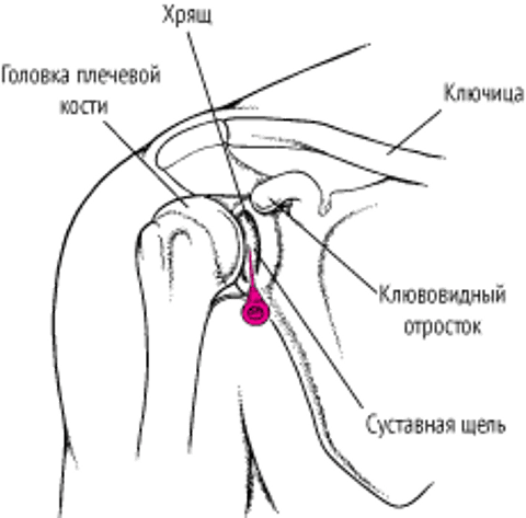 Артроцентез плечевого сустава