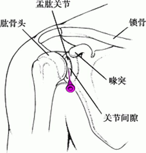 肩关节穿刺术