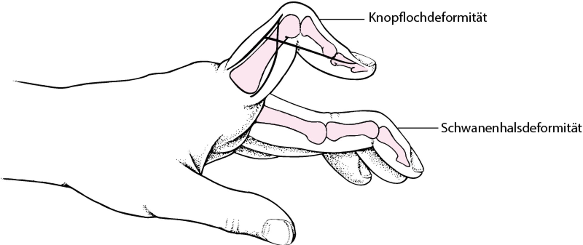 Knopfloch- und Schwanenhalsdeformitäten