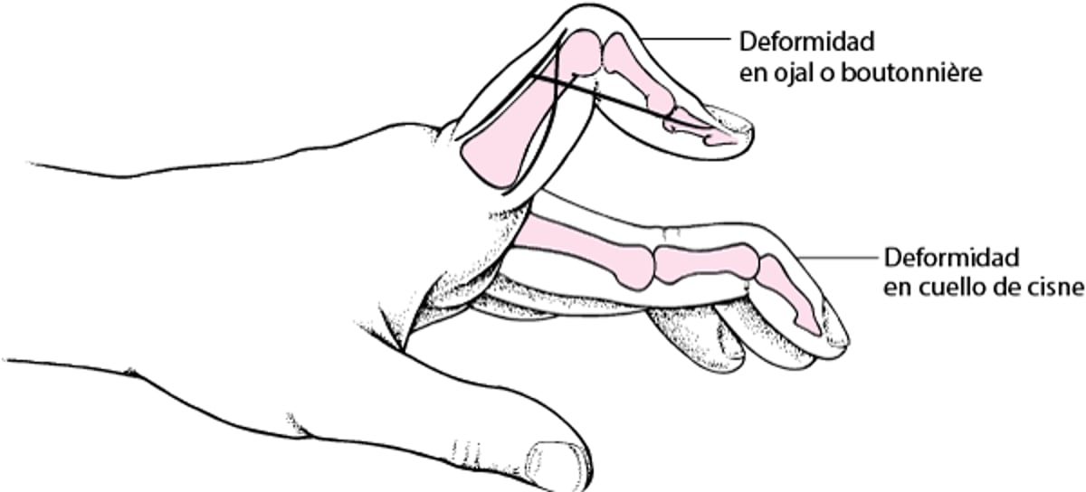 Deformaciones en ojal y en cuello de cisne