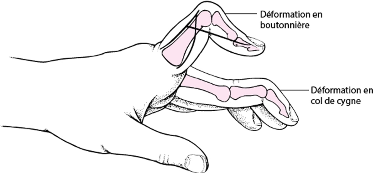 Déformation en boutonnière et col-de-cygne