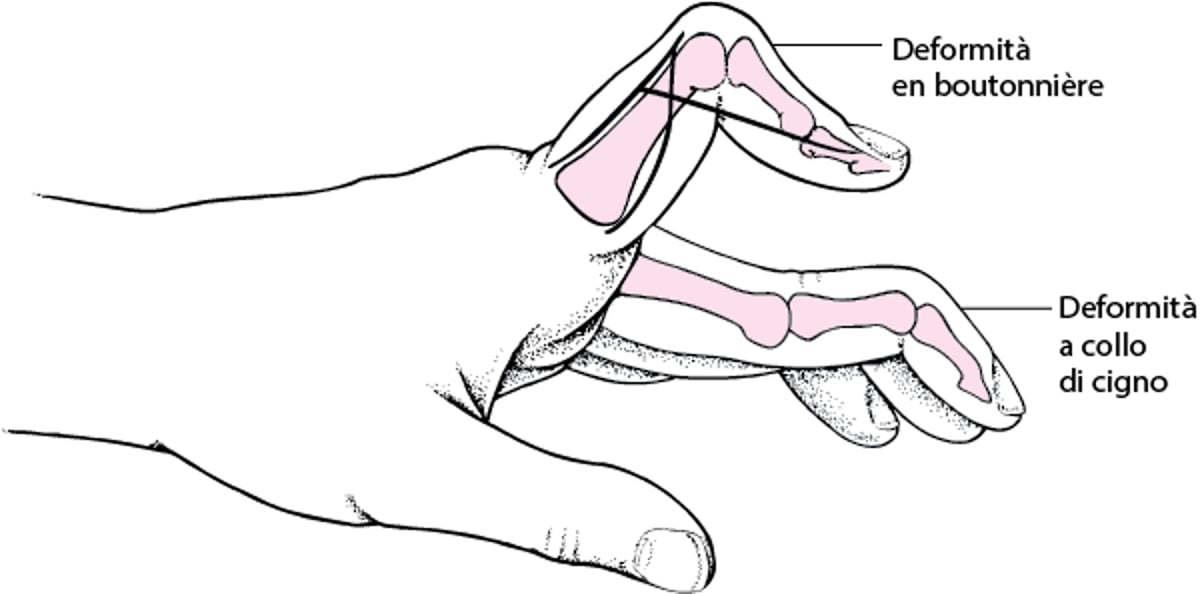 Deformità ad asola (o bottoniera) e a collo di cigno