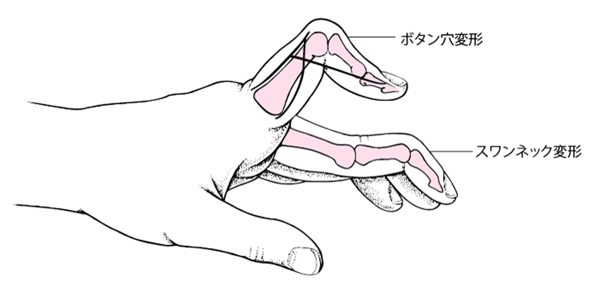 ボタン穴変形およびスワンネック変形