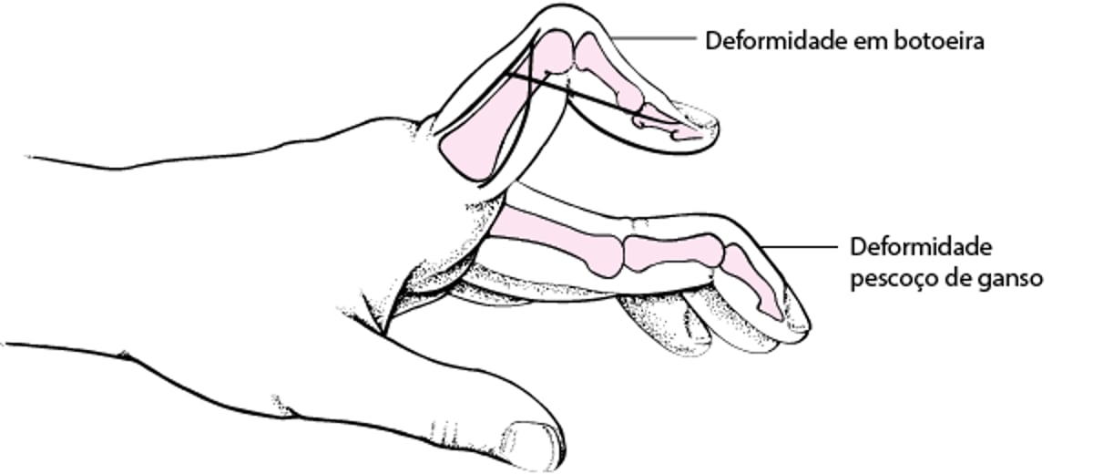 Deformidade em pescoço de cisne e deformidade em botoeira