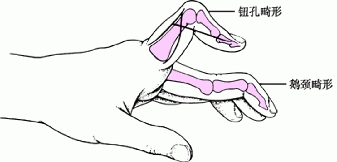 钮扣花畸形和鹅颈样畸形