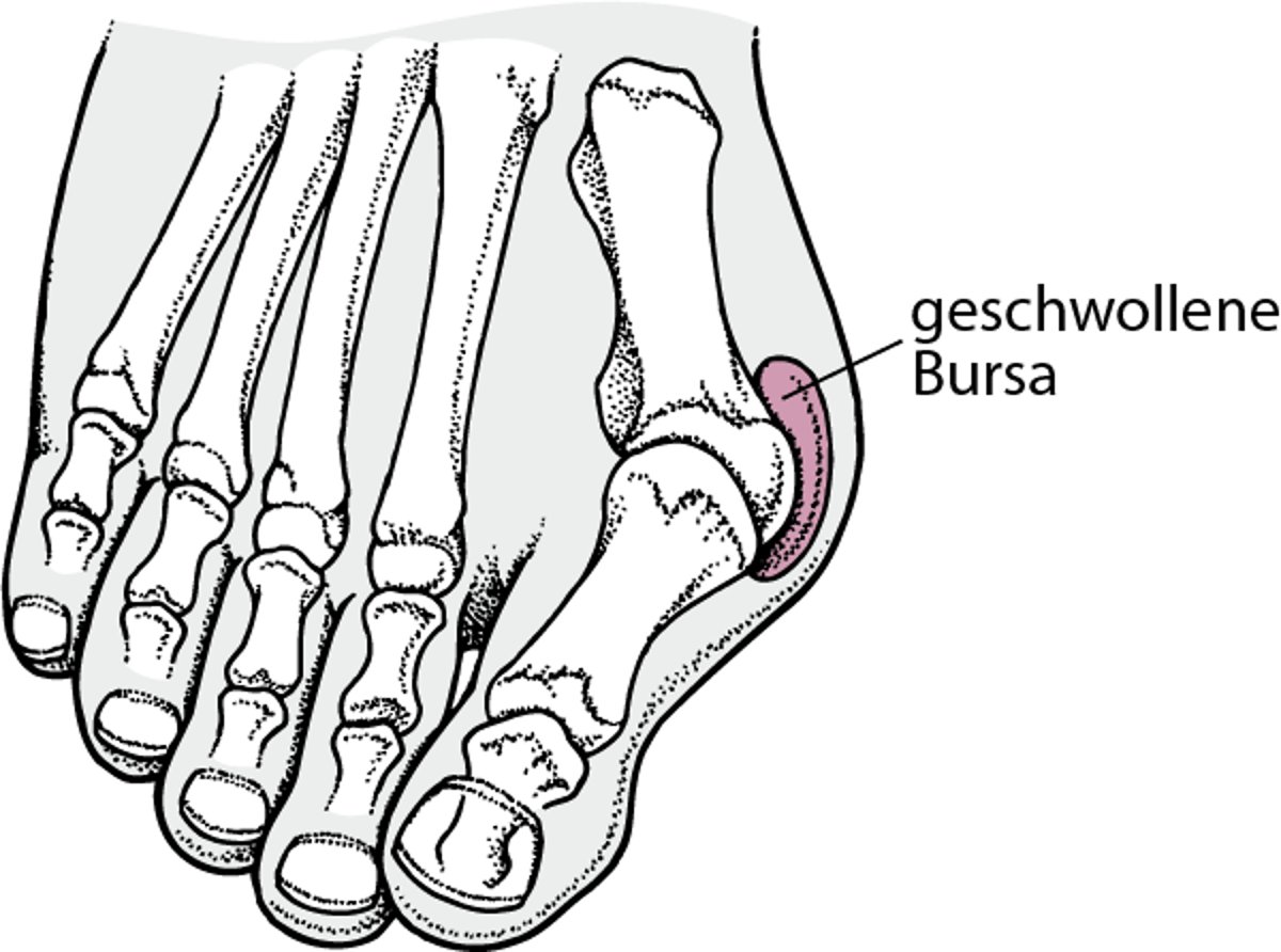 Entzündeter Großzehenballen