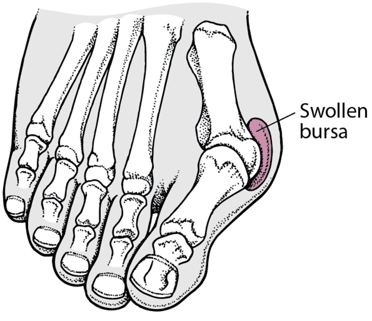 Бурсит большого пальца стопы