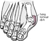 Viêm khớp biến dạng khớp bàn ngón chân cái (Bunion)