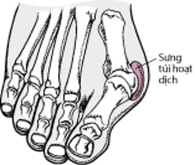 Viêm khớp biến dạng khớp bàn ngón chân cái (Bunion)