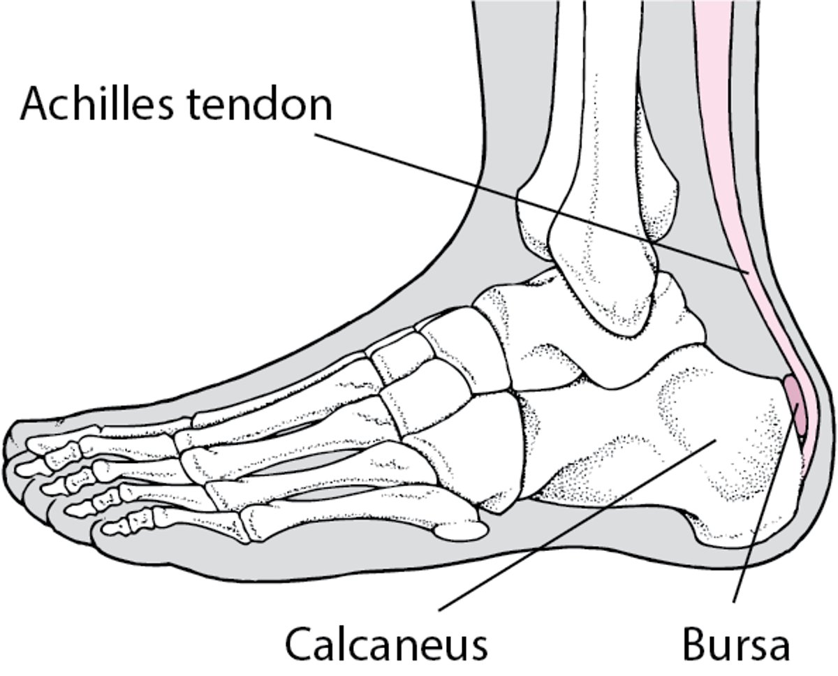 Bursitis in the Heel