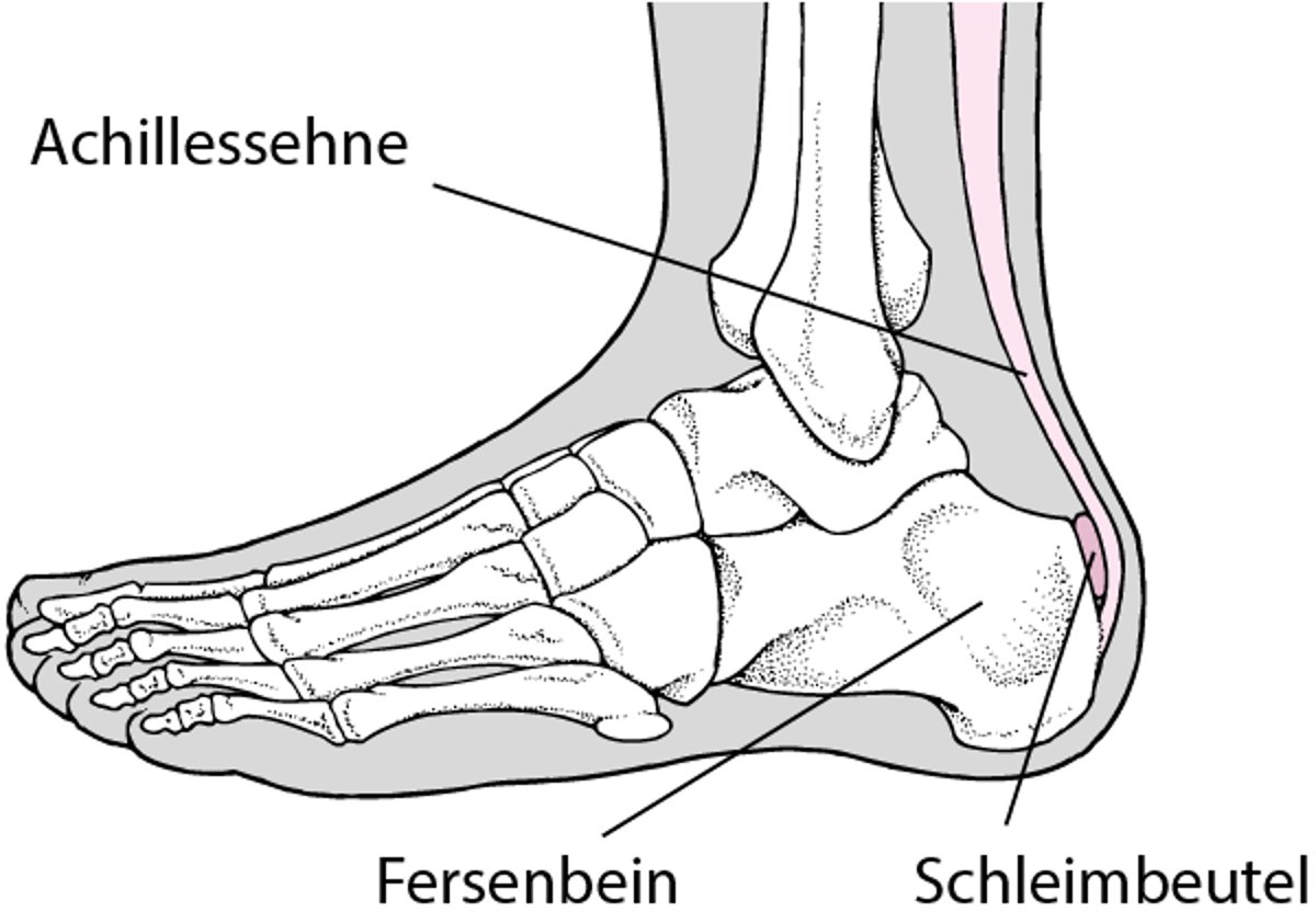 Bursitis in der Ferse