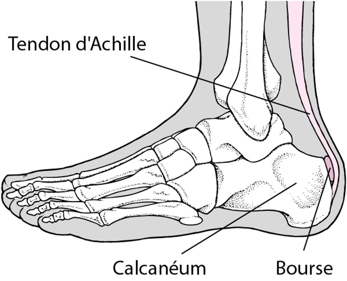Bursite du talon